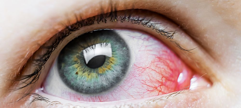 Rote Augen vom Rauchen